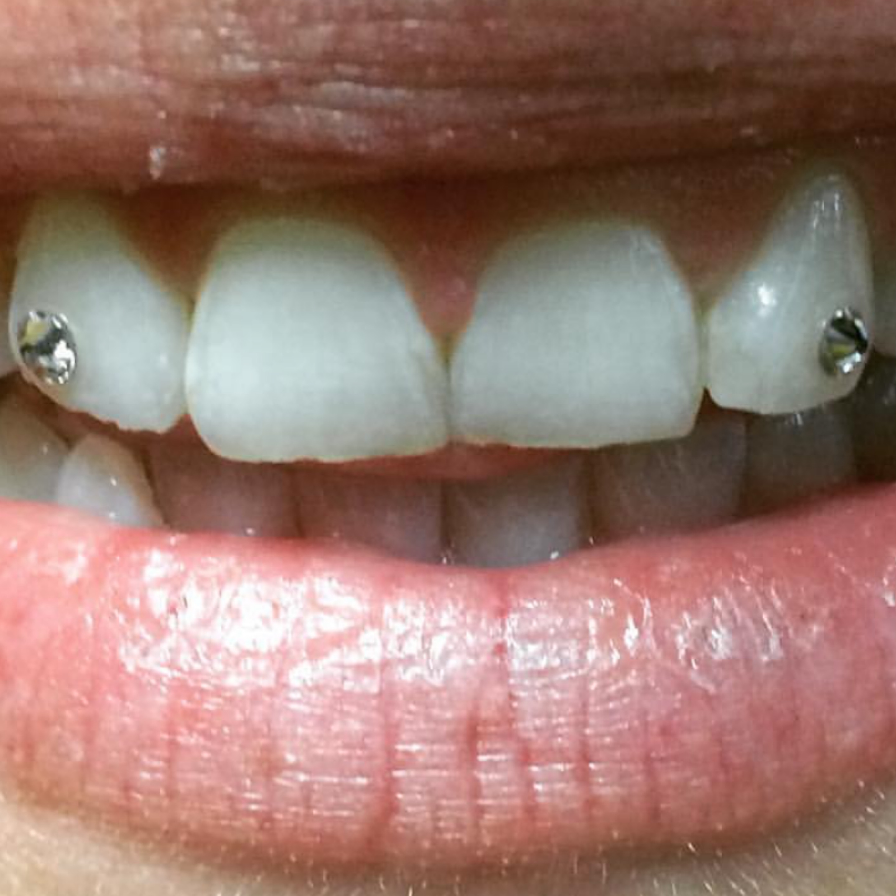 Teeth Whitening/Gem Combo-45min whitening & 2 tooth gems